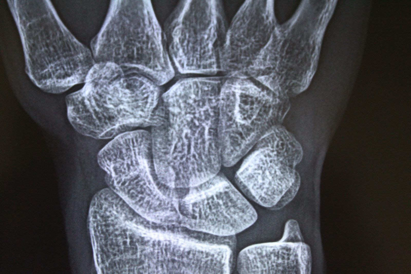 Xray