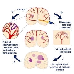 Computational simulation of brain vasculature guides treatment